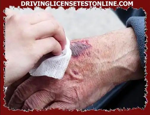 A seguito di un incidente, questa persona ferita ha una ferita aperta che sanguina copiosamente,